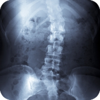 x-ray image of a spine with scoliosis